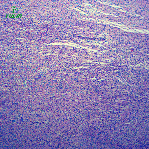 湖北人体肿瘤病理玻片